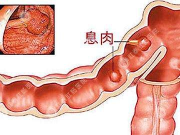 肠息肉到南宁哪家医院治疗